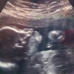 Baby Ultrasound Baby Ultrasound